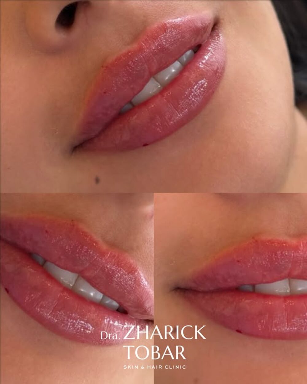 Detalle de resultado con ácido hialurónico, Dra. Zharick Tobar